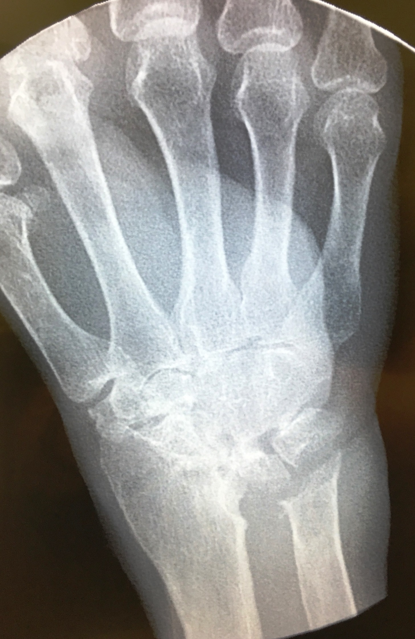 Figure 2 for case Rheumatoid arthritis ( RID3561 )